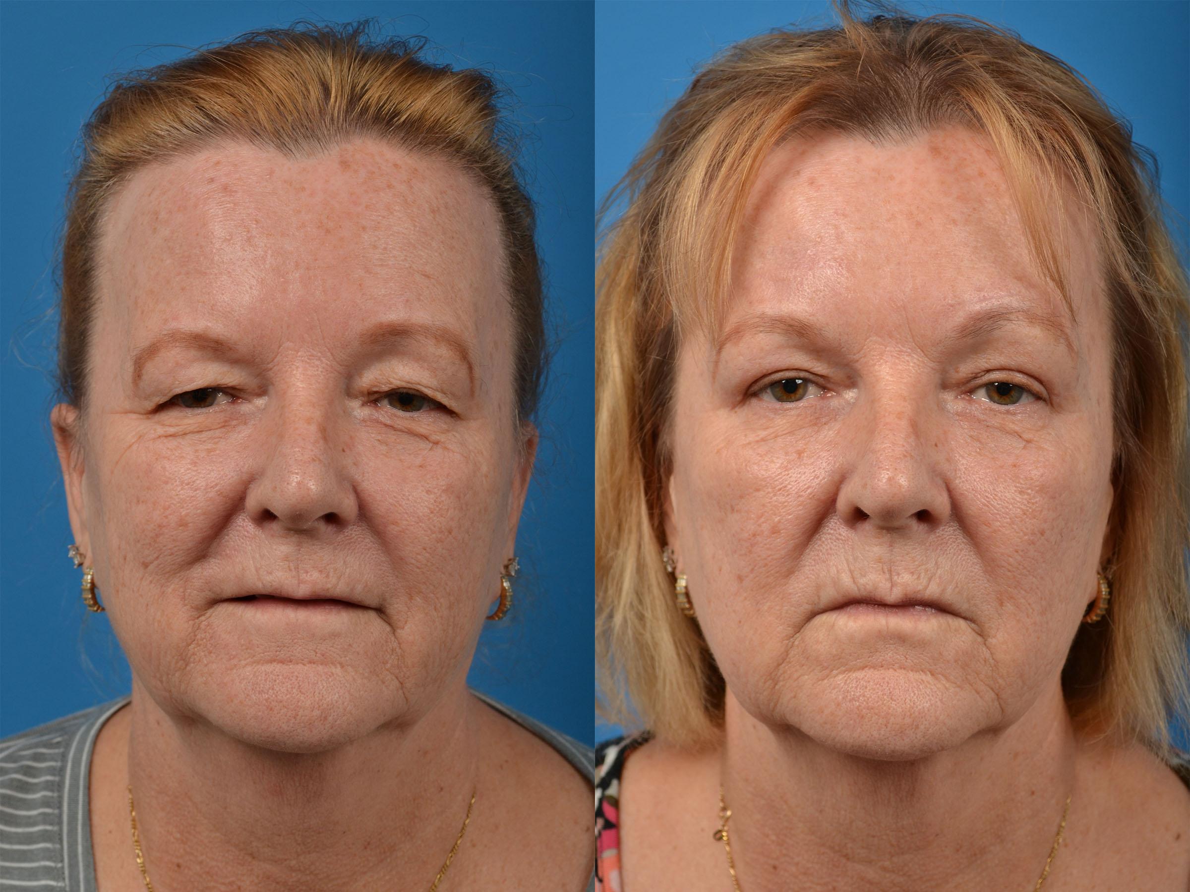 Before & After Photos | Clevens Face & Body Specialists in Florida